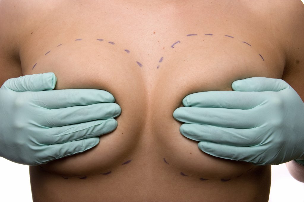 Arizona Breast Augmentation Incisions and Breast Implant Placement