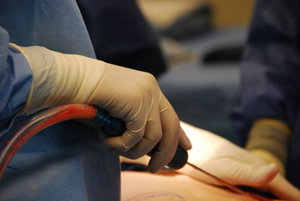 doctor in gloves performing liposuction on patient