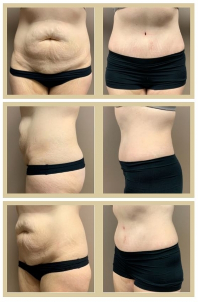 Can Coolsculpting Cause Loose Skin: Myth or Fact?