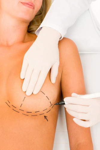 doctor marking a woman's breast for Breast lift incisions