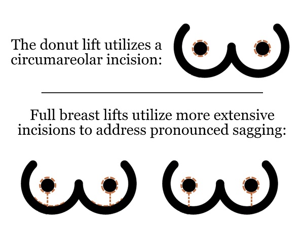 Breast lift incision options Phoenix