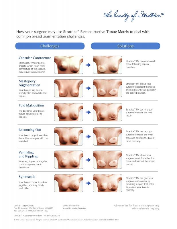 Are Your Breast Implants Bottoming Out?