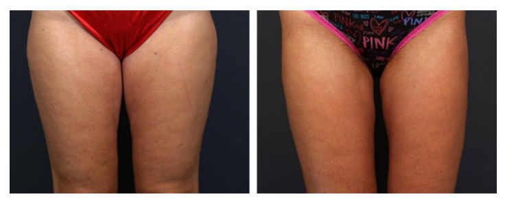 Before and after image of Dr. John Corey's liposuction patient in Phoenix