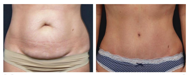 Before and after image of Dr. John Corey's tummy tuck patient in Scottsdale