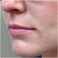 juvederm-for-lips-before-john-corey-aesthetic-plastic-surgery