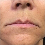 volbella-for-lips-before-image-john-corey-aesthetic-plastic-surgery