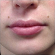 juvederm-for-lips-before-image-john-corey-aesthetic-plastic-surgery