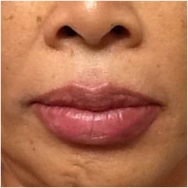 volbella-for-lips-after-image-john-corey-aesthetic-plastic-surgery
