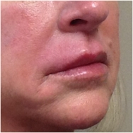juvederm-for-lips-after-john-corey-aesthetic-plastic-surgery
