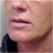 juvederm-and-volbella-for-lips-before-john-corey-aesthetic-plastic-surgery