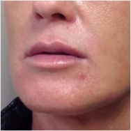 juvederm-and-volbella-for-lips-after-john-corey-aesthetic-plastic-surgery