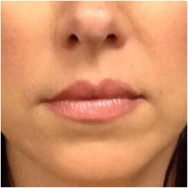 before-lips-fillers-john-corey-aesthetic-plastic-surgery