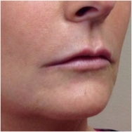 naso-lips-side-after-john-corey-aesthetic-plastic-surgery