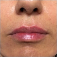 lips-after-image-john-corey-aesthetic-plastic-surgery