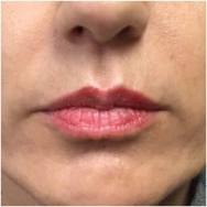 lips-before-image-john-corey-aesthetic-plastic-surgery
