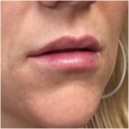 juvederm-lips-after-john-corey-aesthetic-plastic-surgery