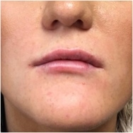 after-juvederm-lips-john-corey-aesthetic-plastic-surgery