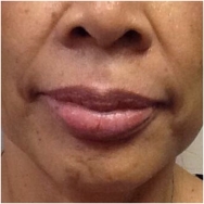 volbella-for-lips-before-image-john-corey-aesthetic-plastic-surgery