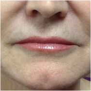 volbella-lips-after-john-corey-aesthetic-plastic-surgery