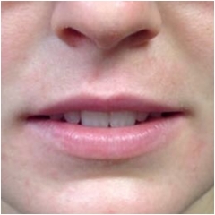 juvederm-for-lips-before-john-corey-aesthetic-plastic-surgery