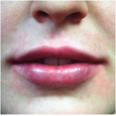 juvederm-for-lips-after-john-corey-aesthetic-plastic-surgery