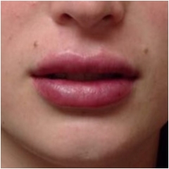 juvederm-for-lips-after-image-john-corey-aesthetic-plastic-surgery