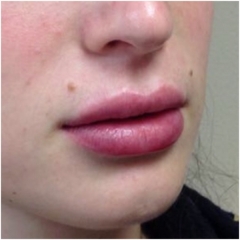 juvederm-for-lips-after-image-john-corey-aesthetic-plastic-surgery