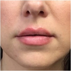 after-lips-fillers-john-corey-aesthetic-plastic-surgery