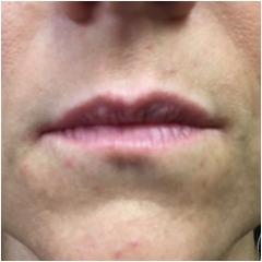 juvederm-lips-before-john-corey-aesthetic-plastic-surgery