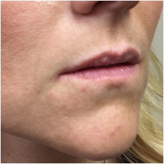 juvederm-lips-before-john-corey-aesthetic-plastic-surgery