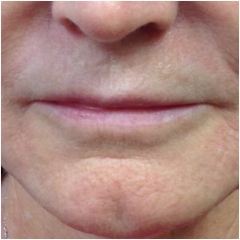 volbella-lips-before-john-corey-aesthetic-plastic-surgery
